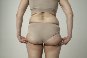 Lipedema pode atingir uma em cada oito mulheres brasileiras e ser confundido com obesidade