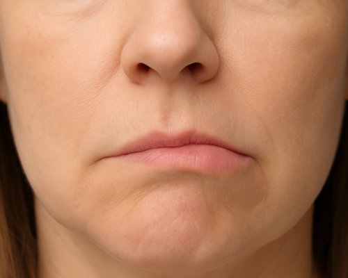 Síndrome de Bell: conheça a doença que paralisa metade do rosto