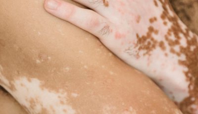 Dia Mundial do Vitiligo: doença pode surgir antes dos 30 anos e diagnóstico precoce faz diferença no tratamento