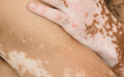Dia Mundial do Vitiligo: doença pode surgir antes dos 30 anos e diagnóstico precoce faz diferença no tratamento