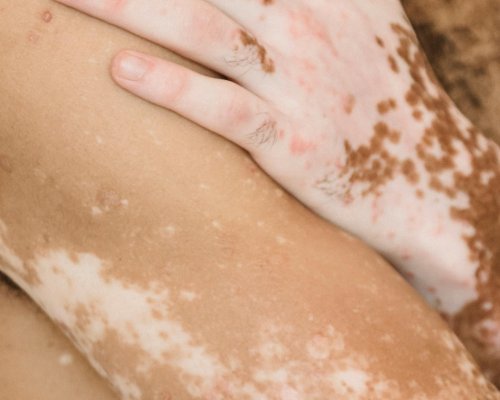 Dia Mundial do Vitiligo: doença pode surgir antes dos 30 anos e diagnóstico precoce faz diferença no tratamento