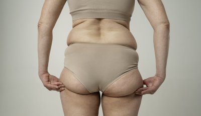 Lipedema pode atingir uma em cada oito mulheres brasileiras e ser confundido com obesidade