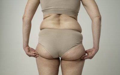 Lipedema pode atingir uma em cada oito mulheres brasileiras e ser confundido com obesidade