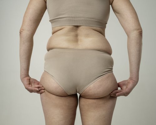 Lipedema pode atingir uma em cada oito mulheres brasileiras e ser confundido com obesidade