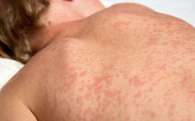 Ribeirão Preto reforça prevenção ao sarampo e intensifica vacinação